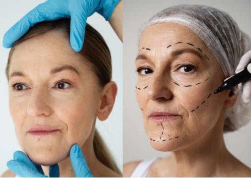 Facelift Surgery