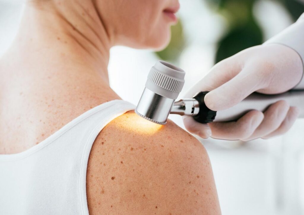 What is Melanoma? Causes, Symptoms, and Treatment Options