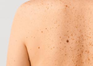 warning signs of skin cancer