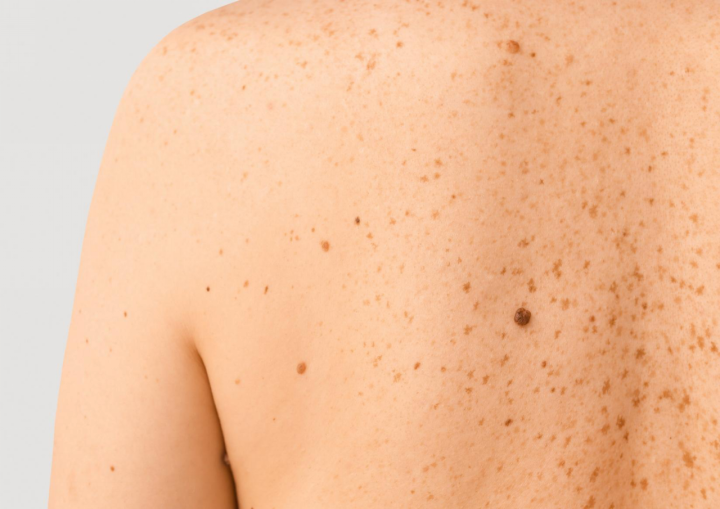 warning signs of skin cancer