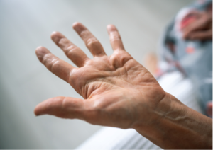 Dupuytren's Contracture